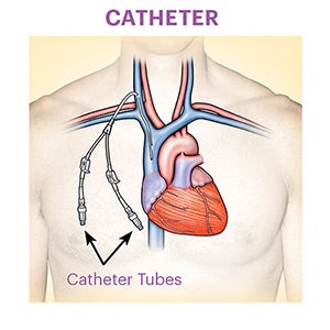 Catheter representation showing a catheter (a thin, flexible tube) connected to a a large vein in the neck/chest region, and two Catheter Tubes available for connection as a result