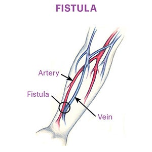 Fistula representation showing the connection of an artery in a forearm to a nearby vein to create an access site.