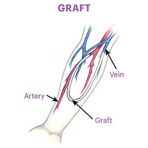 Graft representation showing the connection of an artery and a nearby vein with a small tube to create an access site.