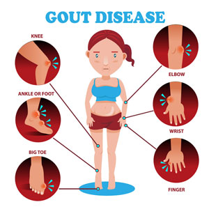 gout treatment