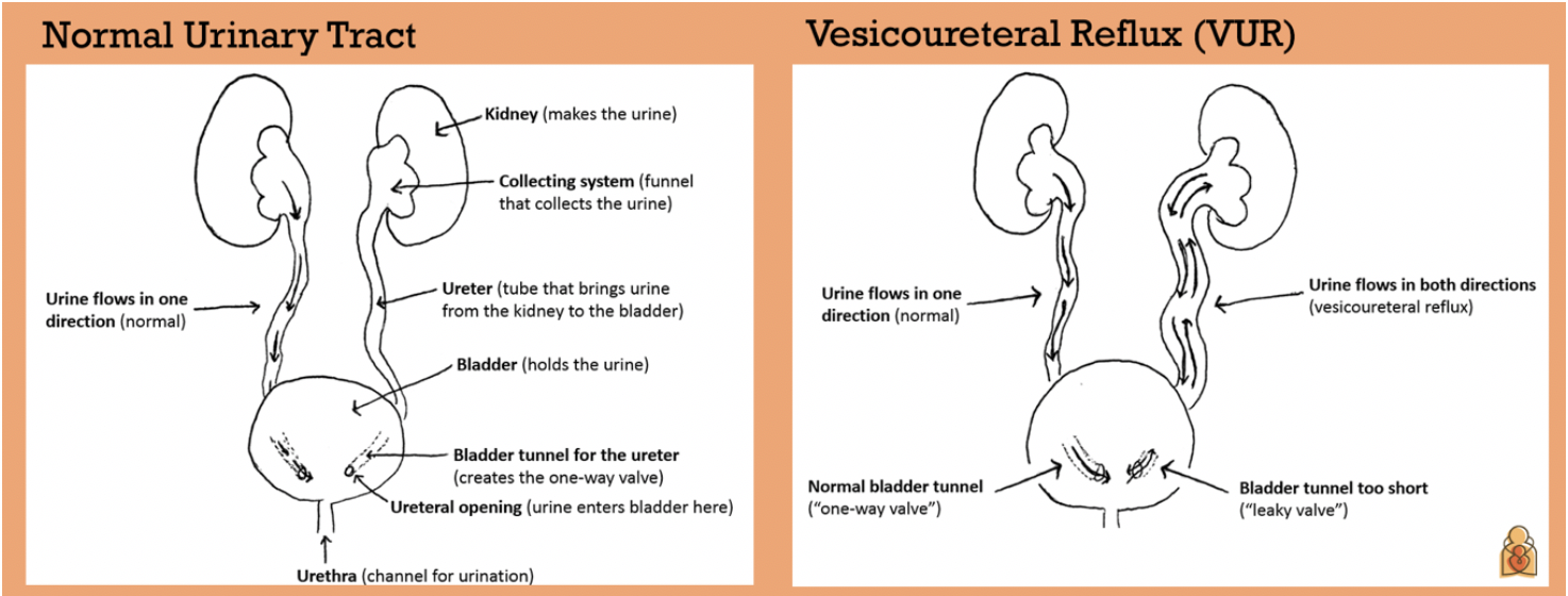 Vesicoureteral Reflux (VUR) in Infants & Children