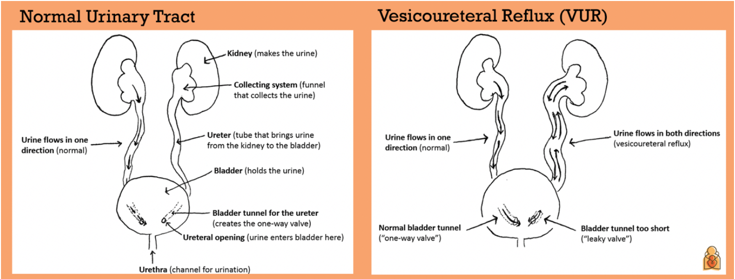 Vesicoureteral Reflux (VUR): Causes, Symptoms & Treatment