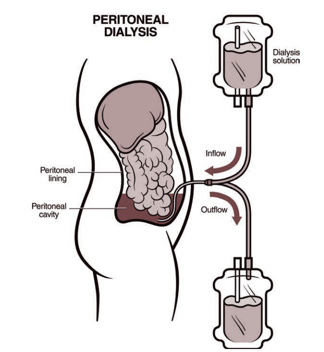 peritoneal dialysis catheter types