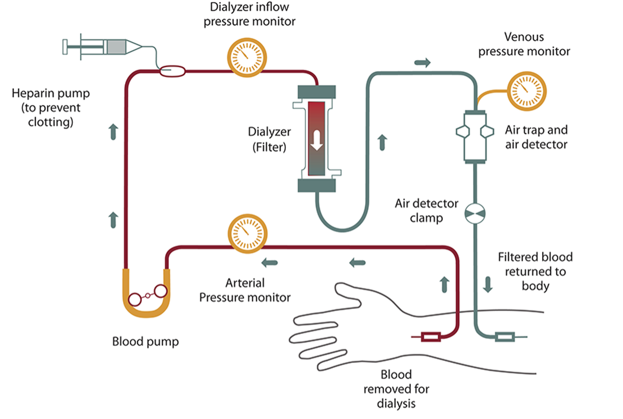 A diagram of the hemodialysis process.