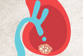 kidney_cancer_homepage.png