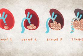 Kidney Cancer Scanning Image